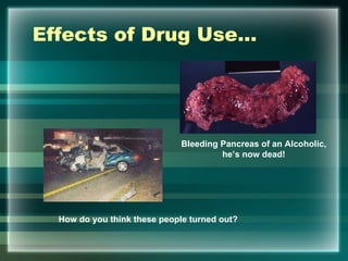 Effects of Drug Use… Bleeding Pancreas of an Alcoholic, he’s now dead! How do you think these people turned out?  