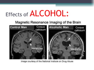 Effects of  ALCOHOL: 