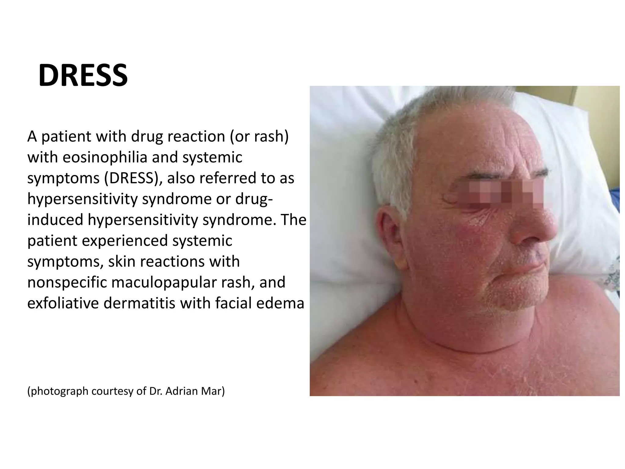 Unexpected Naloxone Reaction?  Could It Be An Allergy? - sa57qlu