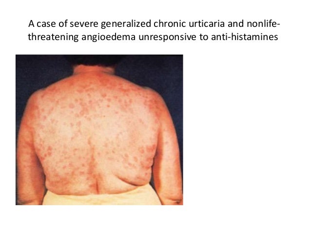 Adverse Reaction And Drug Allergy