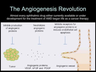The Angiogenesis Revolution Almost every ophthalmic drug either currently available or under development for the treatment of AMD began life as a cancer therapy  