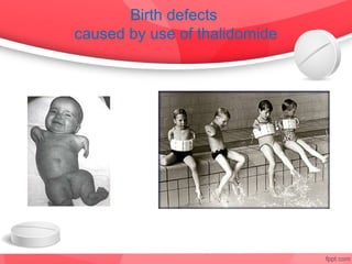 Birth defects
caused by use of thalidomide
 
