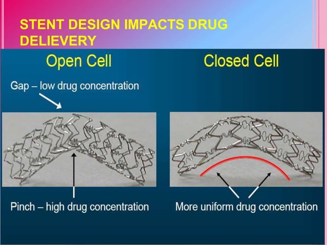 Is Silk Road Stent Drug Eluting Drug eluting stent | PPT