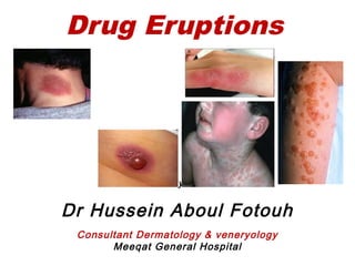Drug Eruptions
By
Dr Hussein Aboul Fotouh
Consultant Dermatology & veneryology
Meeqat General Hospital
 