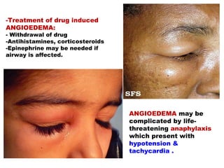ANGIOEDEMA may be
complicated by life-
threatening anaphylaxis
which present with
hypotension &
tachycardia .
-Treatment of drug induced
ANGIOEDEMA:
- Withdrawal of drug
-Antihistamines, corticosteroids
-Epinephrine may be needed if
airway is affected.
 