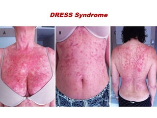 DRESS Syndrome
 