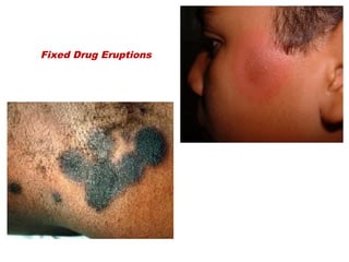 Fixed Drug Eruptions
 