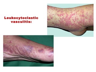 Leukocytoclastic
vasculitis:
 