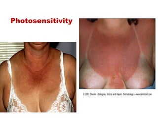 Photosensitivity
 