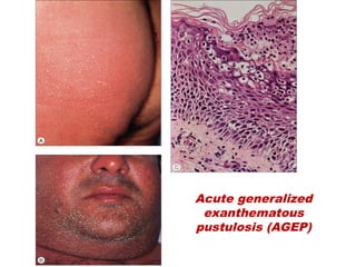 Acute generalized
exanthematous
pustulosis (AGEP)
 
