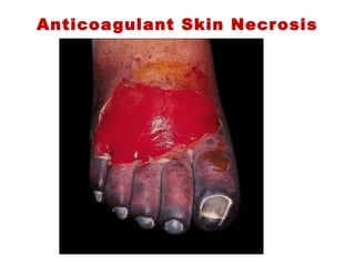 Anticoagulant Skin Necrosis
 