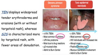 Targetoid Rash Ddx Drug hypersensitivity Prof Ghada Shousha, Assistant Professor of ...