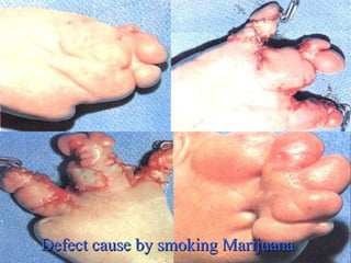 Defect cause by smoking Marijuana 