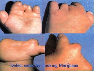 Defect cause by smoking Marijuana 
