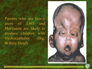 Parents who are heavy users of LSD and Marijuana are likely to produce children with Hydrocephalus (Big, Watery Head) 
