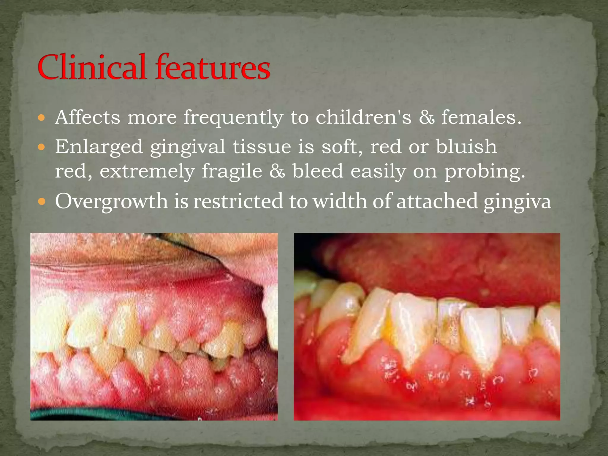 Drug induced gingival enlargement. | PPTX | Dental Health | Diseases ...