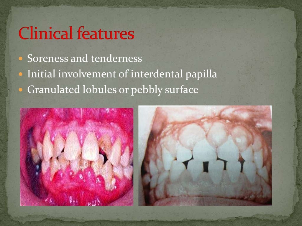 Drug induced gingival enlargement.