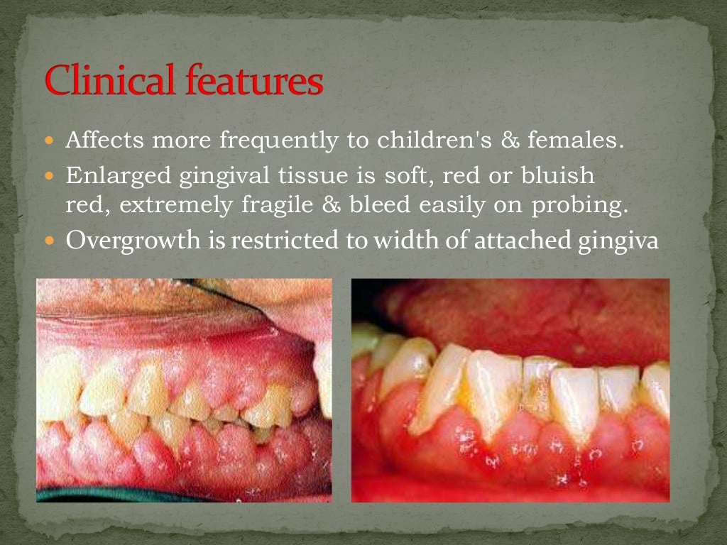 Drug induced gingival enlargement.