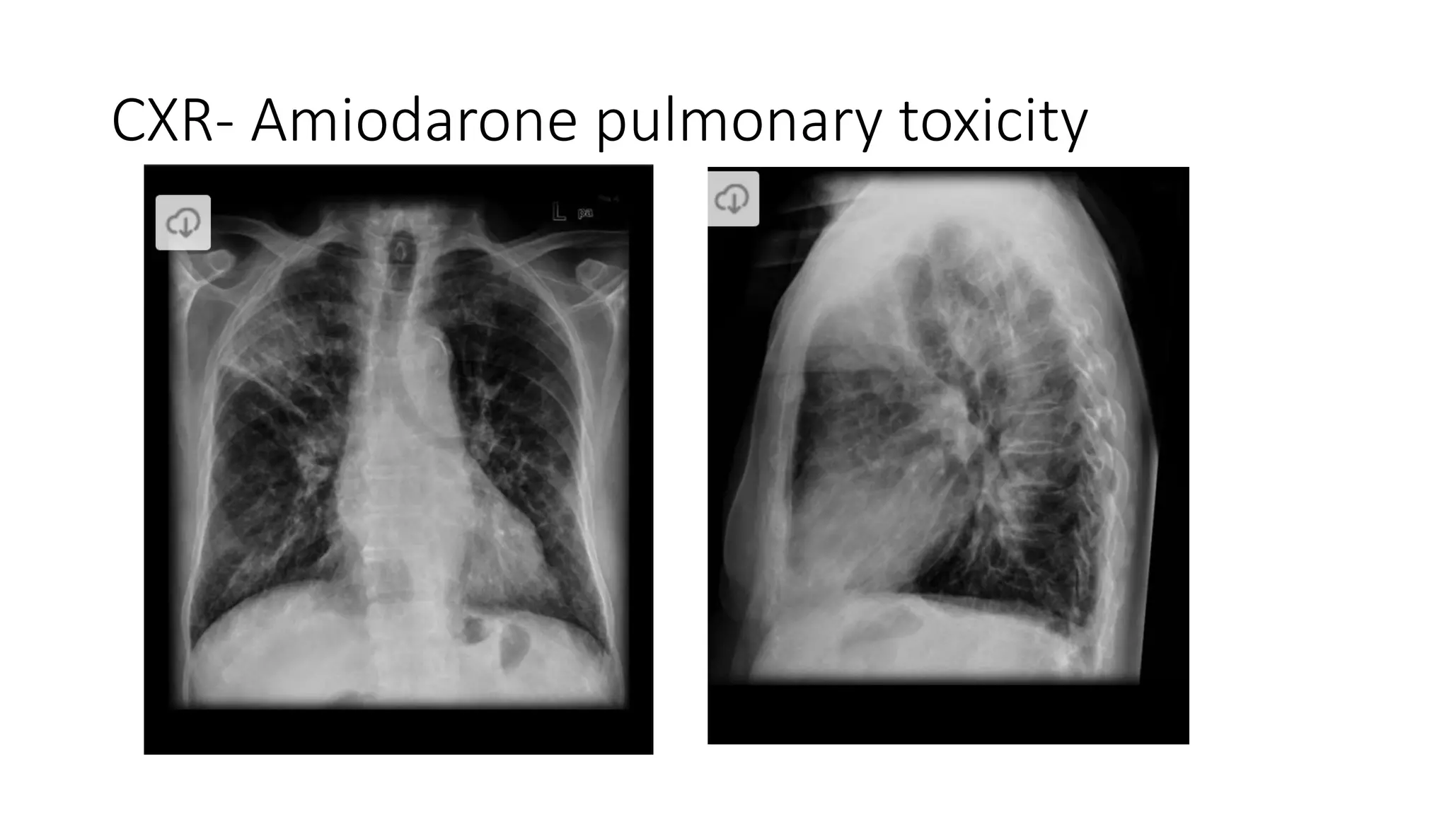 Drug Induced Interstitial Lung Disease.pptx
