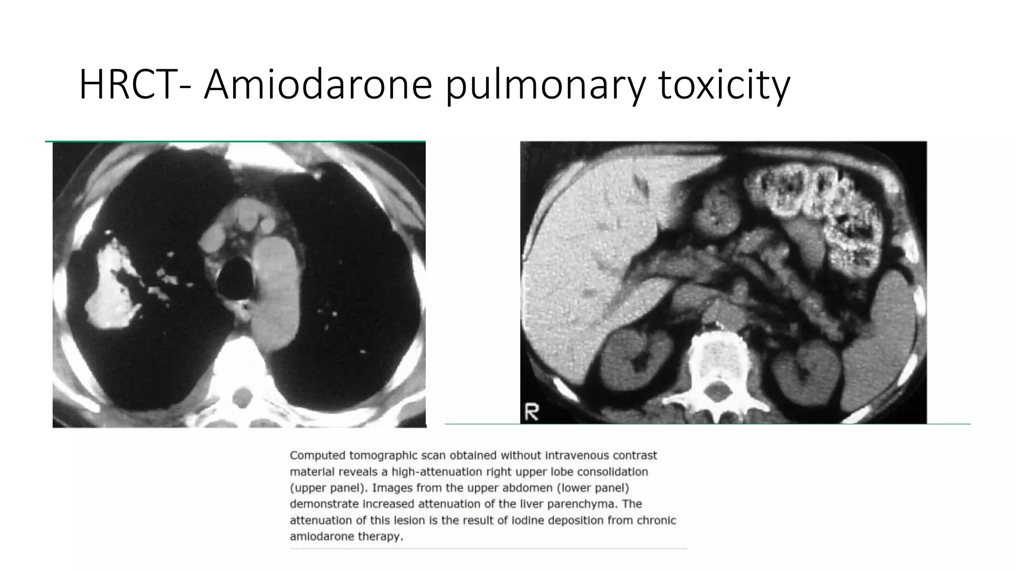 Drug Induced Interstitial Lung Disease.pptx