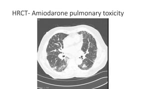 Drug Induced Interstitial Lung Disease.pptx