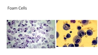 Drug Induced Interstitial Lung Disease.pptx