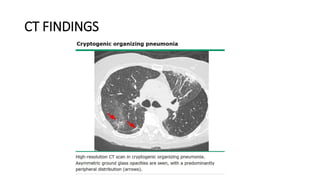 Drug Induced Interstitial Lung Disease.pptx