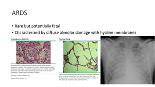 Drug Induced Interstitial Lung Disease.pptx
