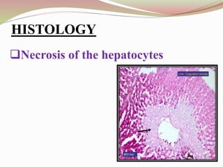 HISTOLOGY:
Necrosis of the hepatocytes
HISTOLOGY
 
