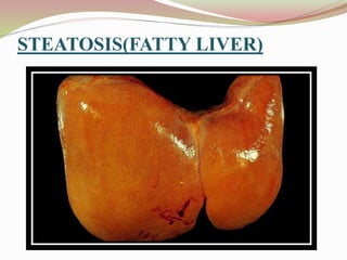 STEATOSIS(FATTY LIVER)
 