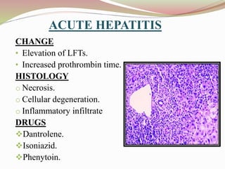ACUTE HEPATITIS
CHANGES:
• Elevation of LFTs.
• Increased prothrombin time.
HISTOLOGY
o Necrosis.
o Cellular degeneration.
o Inflammatory infiltrate
DRUGS
Dantrolene.
Isoniazid.
Phenytoin.
 