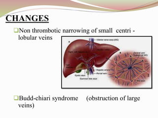 Non thrombotic narrowing of small centri -
lobular veins
Budd-chiari syndrome (obstruction of large
veins)
CHANGES
 
