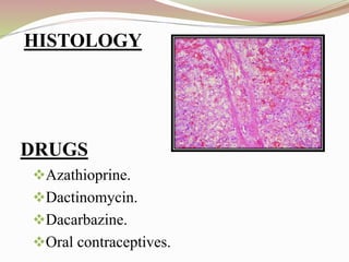 DRUGS
Azathioprine.
Dactinomycin.
Dacarbazine.
Oral contraceptives.
HISTOLOGY
 