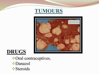 TUMOURS
Oral contraceptives.
Danazol
Steroids
DRUGS
 