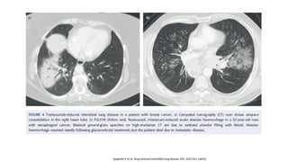 Drug Induced Lung Diseases due to various drug’s | PPTX