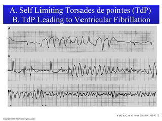 A. Self Limiting Torsades de pointes (TdP)
        B. TdP Leading to Ventricular Fibrillation




                                            Yap, Y. G. et al. Heart 2003;89:1363-1372
Copyright ©2003 BMJ Publishing Group Ltd.
 
