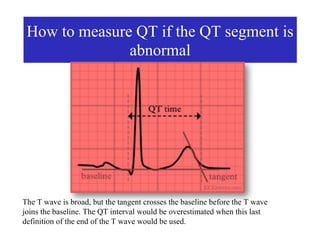 How to measure QT if the QT segment is
               abnormal




The T wave is broad, but the tangent crosses the baseline before the T wave
joins the baseline. The QT interval would be overestimated when this last
definition of the end of the T wave would be used.
 