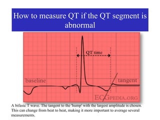 How to measure QT if the QT segment is
               abnormal




A bifasic T wave. The tangent to the 'hump' with the largest amplitude is chosen.
This can change from beat to beat, making it more important to average several
measurements.
 