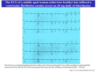 The ECG of a middle aged woman (otherwise healthy) but suffered a
ventricular fibrillation cardiac arrest on 20 mg daily of thioridazine




This ECG was recorded immediately after the cardiac arrest. Note the prolonged T wave offset resulting in a prolonged QTc
interval of 619 ms. (B) The ECG of the same patient three days after the withdrawal of thioridazine (QTc = 399 ms).
                                                                                           Yap, Y. G. et al. Heart 2003;89:1363-1372
 