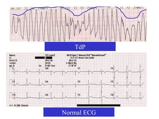 TdP




Normal ECG
 