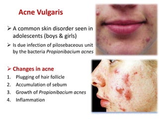 Acne Vulgaris
 A common skin disorder seen in
adolescents (boys & girls)
 Is due infection of pilosebaceous unit
by the bacteria Propionibacium acnes
 Changes in acne
1. Plugging of hair follicle
2. Accumulation of sebum
3. Growth of Propionibacium acnes
4. Inflammation
 