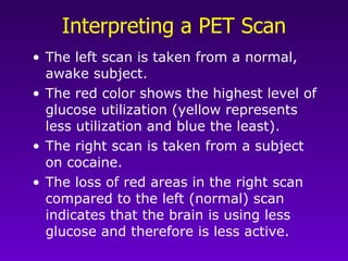 Interpreting a PET Scan The left scan is taken from a normal, awake subject.  The red color shows the highest level of glucose utilization (yellow represents less utilization and blue the least).  The right scan is taken from a subject on cocaine.  The loss of red areas in the right scan compared to the left (normal) scan indicates that the brain is using less glucose and therefore is less active.  