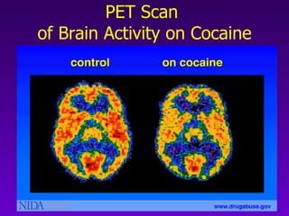 PET Scan  of Brain Activity on Cocaine 