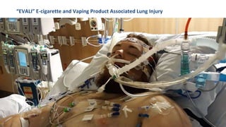“EVALI” E-cigarette and Vaping Product Associated Lung Injury
25
 