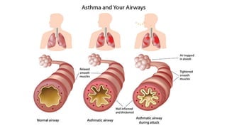 Drugs for treatment of Bronchial Asthma including pathology physiology ...