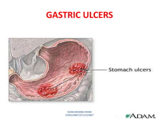 GASTRIC ULCERS
SSEMUWEMBA FRANK
0706319897/0712319897
 