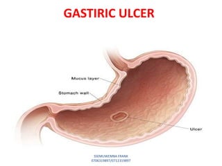 GASTIRIC ULCER
SSEMUWEMBA FRANK
0706319897/0712319897
 