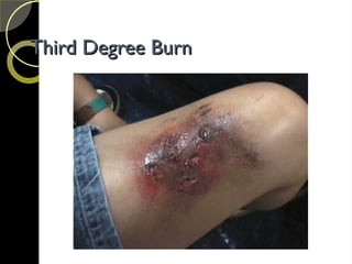 Third Degree Burn
Third Degree Burn
 
