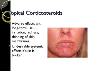Topical Corticosteroids
Topical Corticosteroids
 Adverse effects with
long-term use—
irritation, redness,
thinning of skin
membranes.
 Undesirable systemic
effects if skin is
broken.
 