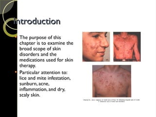 Introduction
Introduction
 The purpose of this
chapter is to examine the
broad scope of skin
disorders and the
medications used for skin
therapy.
 Particular attention to:
lice and mite infestation,
sunburn, acne,
inflammation, and dry,
scaly skin.
 